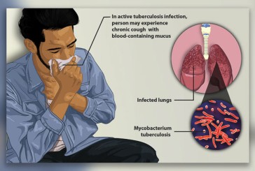 Tuberculosis cases on the rise globally and in Washington state